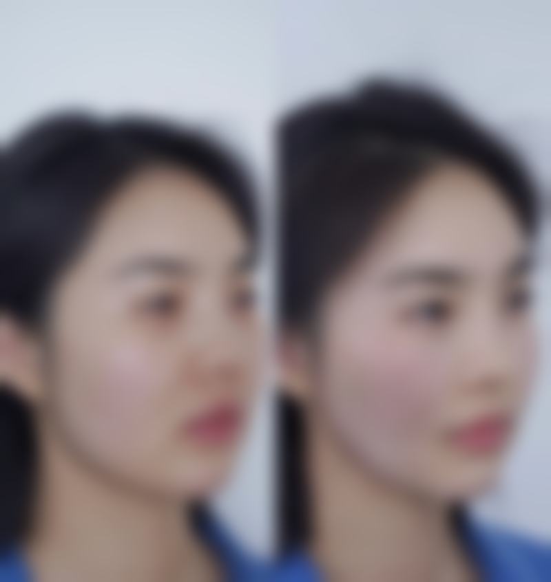 我在韩国宝尼达，用脂肪干细胞修复疤痕重获自信啦！ 