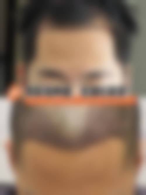 深圳鹏程植发怎么样价格收费