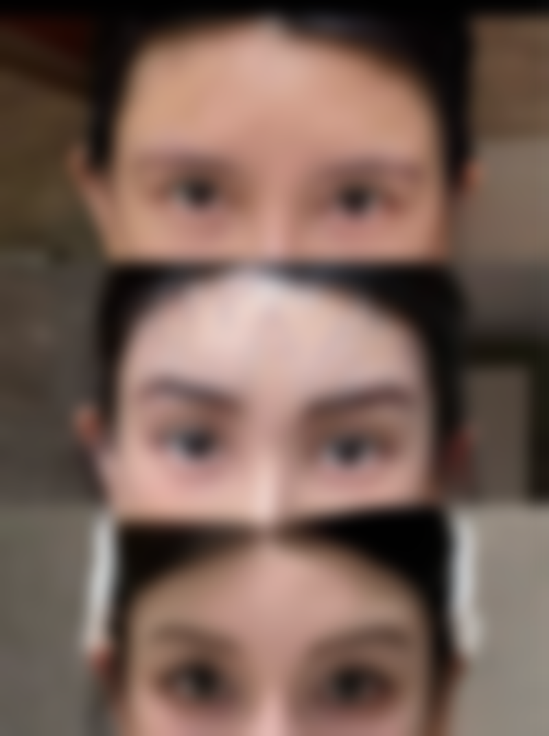 深圳鹏程植发怎么样求美者反馈