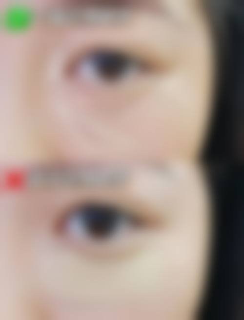 杨光朝医生运用的特色精良技术