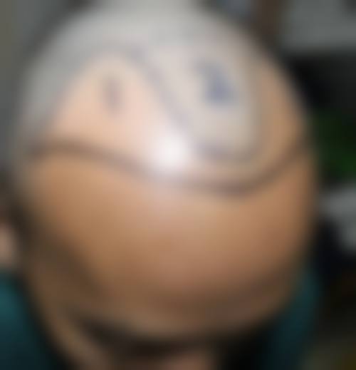 蔡允剑医生的植发保护