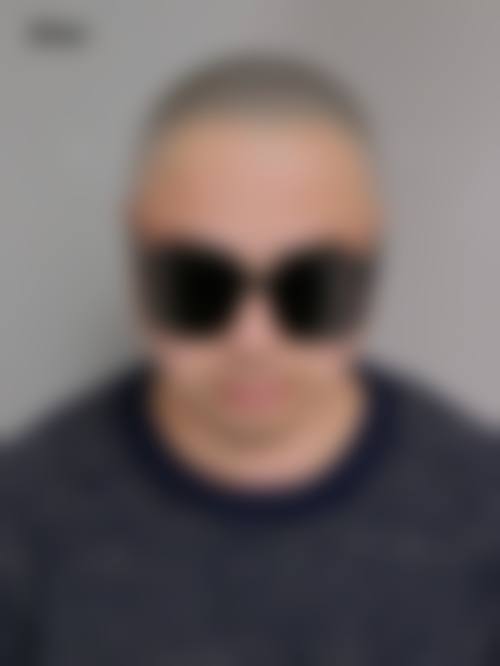 蔡允剑医生植发的保护优势