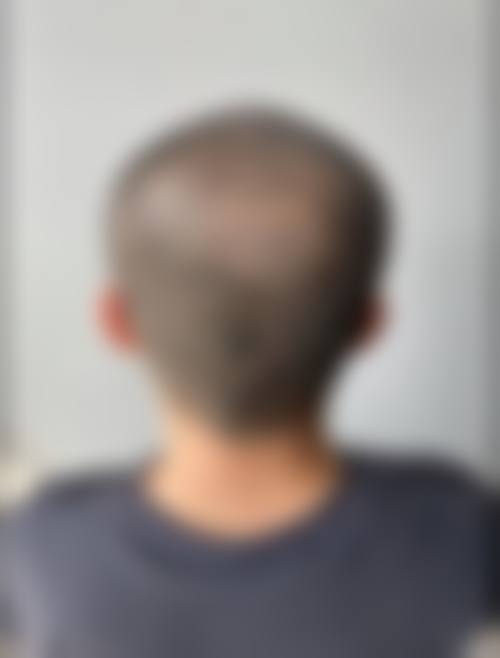 蔡允剑医生的植发价格