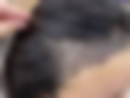 蔡允剑医生擅长的植发技术