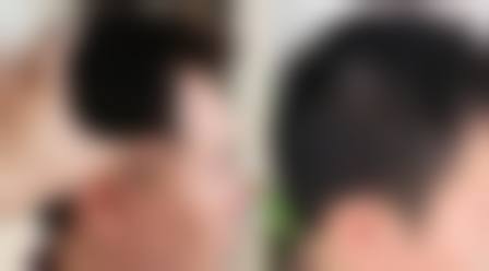 厦门碧莲盛无痕植发整形怎么样求美者反馈