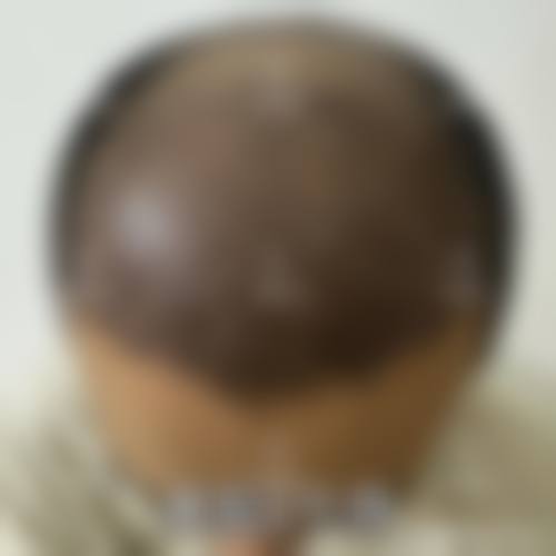 成都恒美植发连锁怎么样医生团队实力