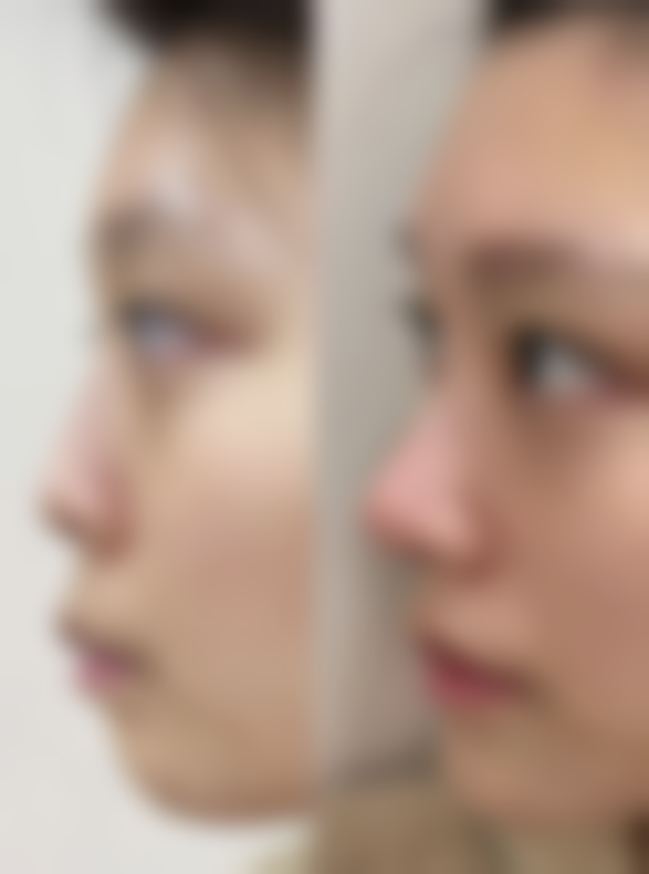 厦门欣赫拉整形医院怎么样求美者反馈