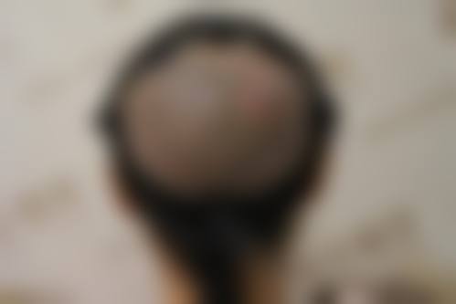 南京领秀植发医院怎么样特色项目及技术优势