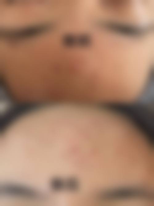 韩国forhair毛发移植中 心医院怎么样医生团队实力