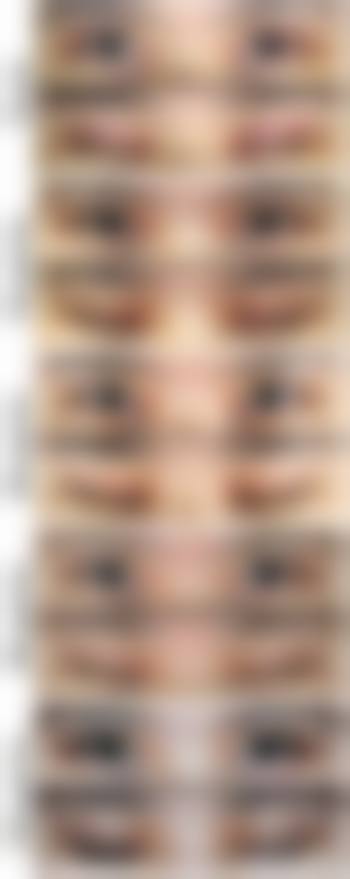 金玹秀院长的MISKO隆鼻特色