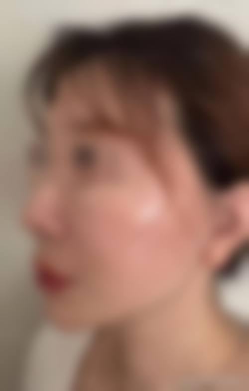 韩国清潭ES整形外科怎么样求美者反馈