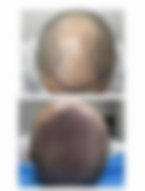 佛山大麦微针植发怎么样简介概述