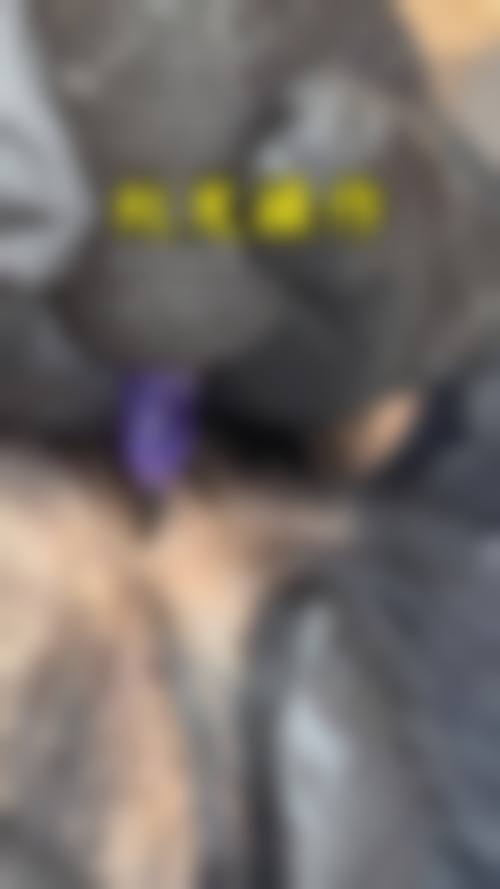 佛山大麦微针植发怎么样价格收费