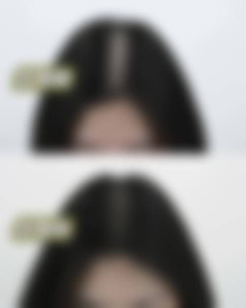 佛山大麦微针植发怎么样求美者反馈