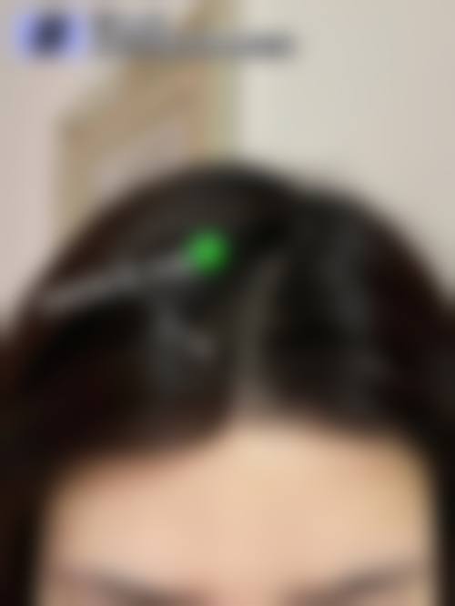 上海411医院植发科求美者反馈