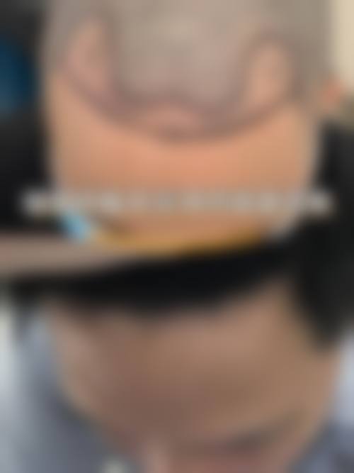 无锡百年植发医院特色项目及技术优势