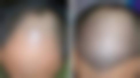 合肥倍植植发诊所特色项目及技术优势