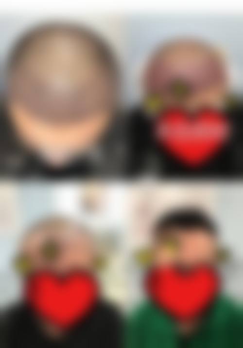重庆仁爱医院毛发移植中 心价格收费