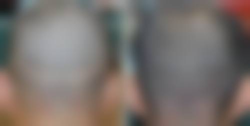 黄东亮主治医师应用的核心植发技术