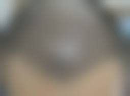 透明合理的植发收费体系